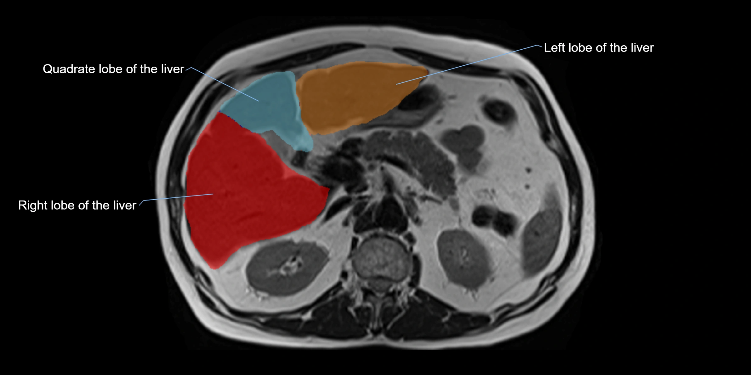 MRI liver lobe axial cross sectional 3T radiology  image-img-00001-00017.webp